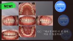 교정 Case 834. 재교정, Tilted Occlusal Table, Arch Coordination, Sem #19