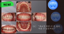 교정 Case 834. 재교정, Tilted Occlusal Table, Arch Coordination, Sem #19