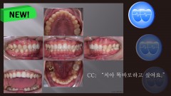 교정 Case 1321. 비발치, Severe Lower Crowding, Sem #11