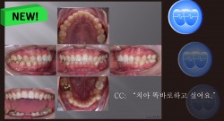 교정 Case 1321. 비발치, Severe Lower Crowding, Sem #11