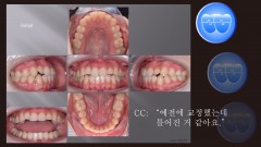 교정 Case 1100. U7L4 발치, Molar Extraction, 재교정, 비발치의 문제점, Sem #13.3