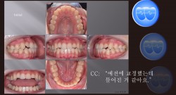 교정 Case 1100. U7L4 발치, Molar Extraction, 재교정, 비발치의 문제점, Sem #13.3