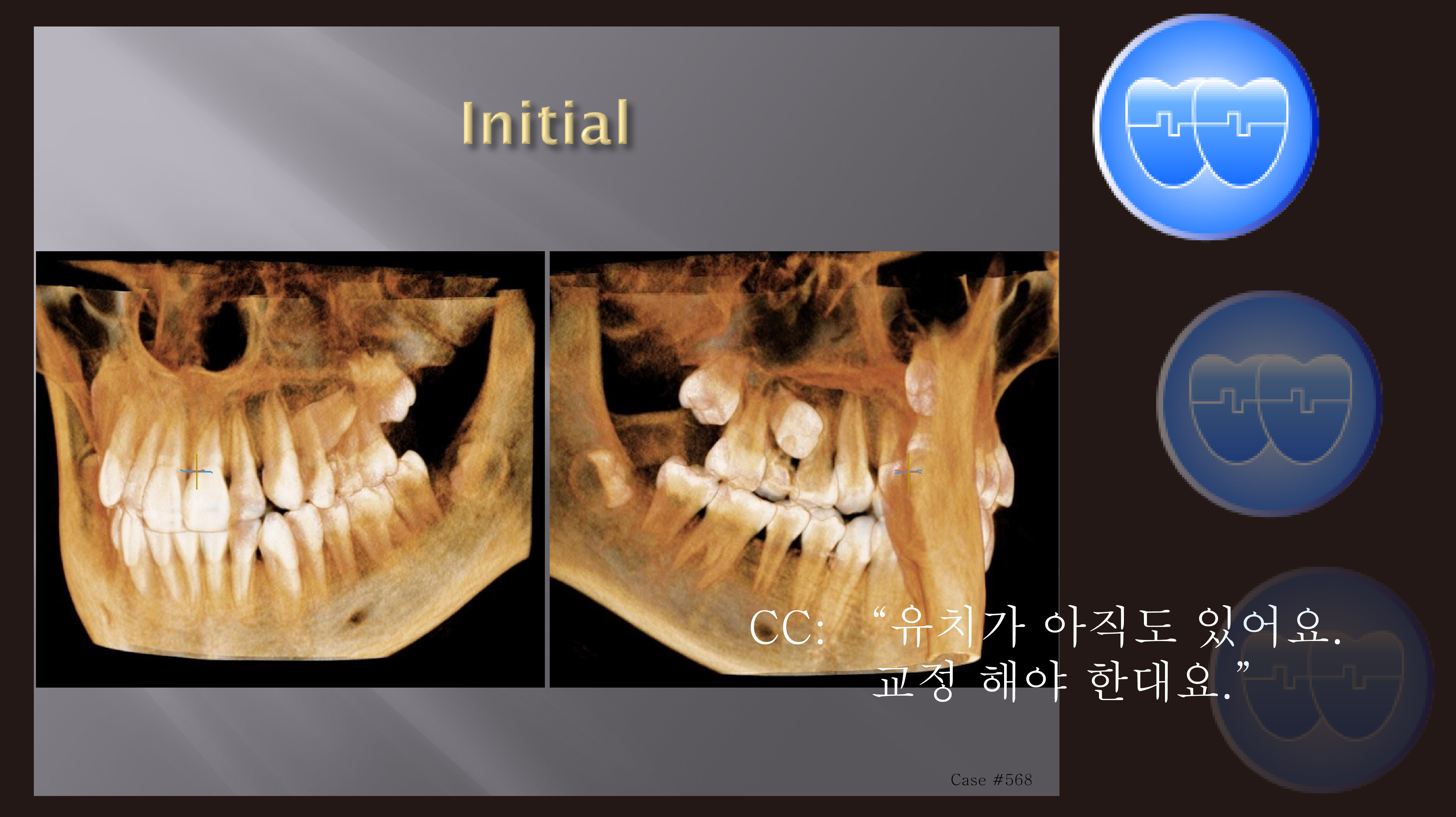 교정 Case 568. 비발치, #25 Impaction, Bad Oral Hygiene, Sem #14