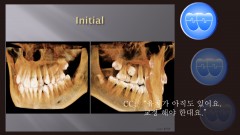 교정 Case 568. 비발치, #25 Impaction, Bad Oral Hygiene, Sem #14