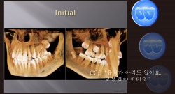교정 Case 568. 비발치, #25 Impaction, Bad Oral Hygiene, Sem #14