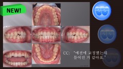교정 Case 1100. U7L4 발치, Molar Extraction, 재교정, 비발치의 문제점, Sem #13.3