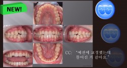 교정 Case 1100. U7L4 발치, Molar Extraction, 재교정, 비발치의 문제점, Sem #13.3