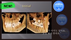 교정 Case 568. 비발치, #25 Impaction, Bad Oral Hygiene, Sem #14