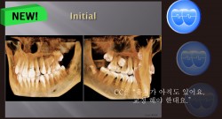 교정 Case 568. 비발치, #25 Impaction, Bad Oral Hygiene, Sem #14