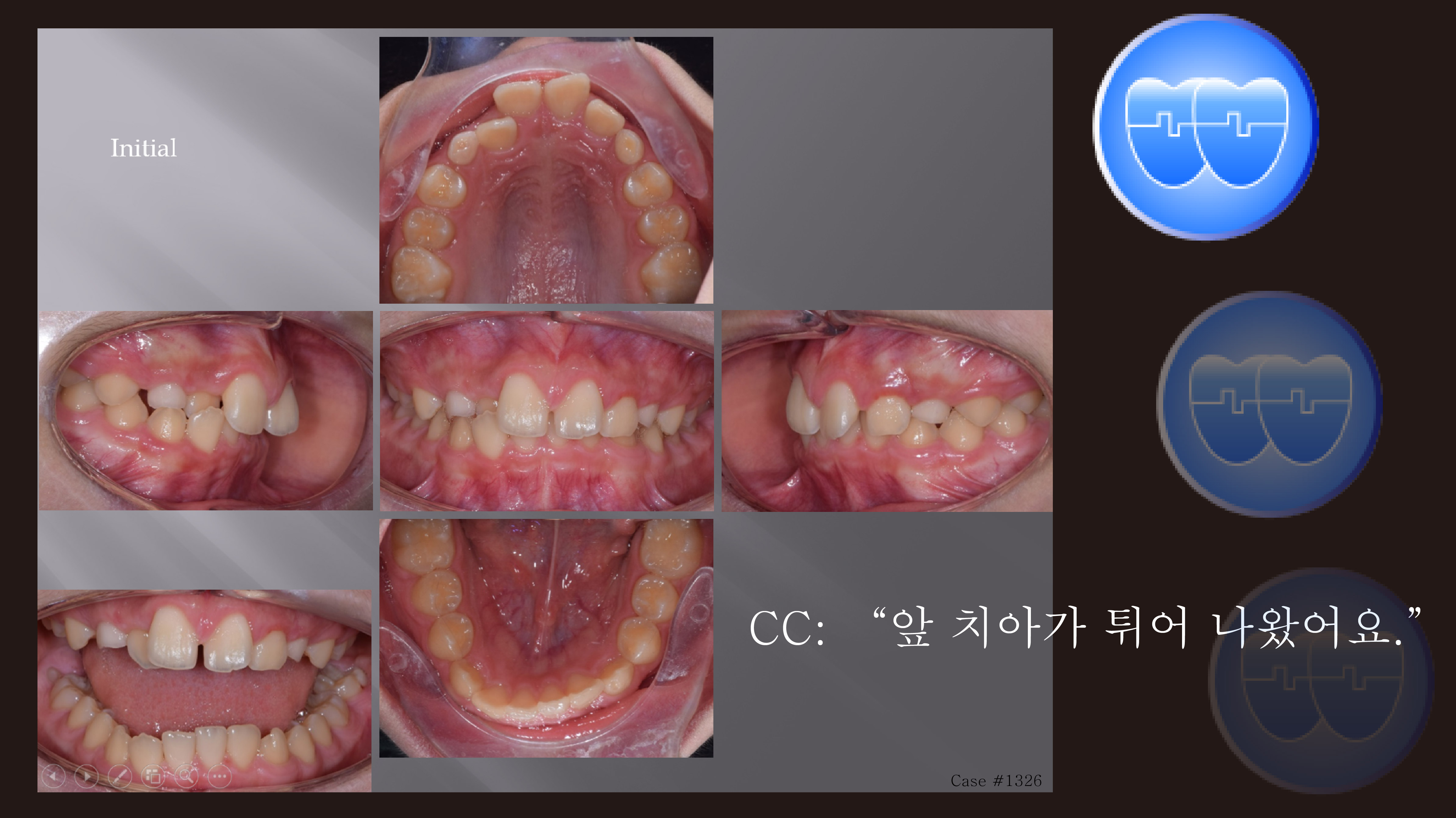 교정 Case 1326. 비발치, Anterior Crossbite, Deepbite, Mandibular Shift의 조기 치료, Sem #19