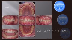 교정 Case 1326. 비발치, Anterior Crossbite, Deepbite, Mandibular Shift의 조기 치료, Sem #19