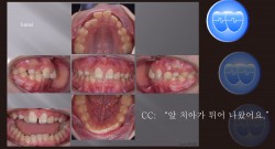 교정 Case 1326. 비발치, Anterior Crossbite, Deepbite, Mandibular Shift의 조기 치료, Sem #19