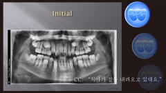 교정 Case 1305. 비발치, Impactions of #15 and #25, Sem #14