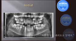 교정 Case 1305. 비발치, Impactions of #15 and #25, Sem #14