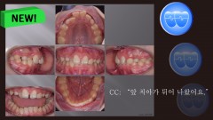 교정 Case 1326. 비발치, Anterior Crossbite, Deepbite, Mandibular Shift의 조기 치료, Sem #19