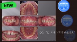 교정 Case 1326. 비발치, Anterior Crossbite, Deepbite, Mandibular Shift의 조기 치료, Sem #19