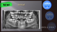 교정 Case 1305. 비발치, Impactions of #15 and #25, Sem #14