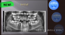 교정 Case 1305. 비발치, Impactions of #15 and #25, Sem #14