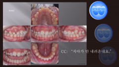 교정 Case 1289. U5 발치, Protrusion, Tooth Necrosis #23, Sem #14