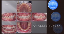 교정 Case 1289. U5 발치, Protrusion, Tooth Necrosis #23, Sem #14