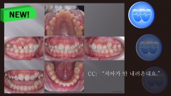 교정 Case 1289. U5 발치, Protrusion, Tooth Necrosis #23, Sem #14