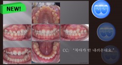 교정 Case 1289. U5 발치, Protrusion, Tooth Necrosis #23, Sem #14