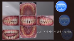 교정 Case 1379. 비발치, Anterior Space를 Close하는 Mechanic Ideas, Sem #3