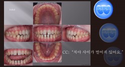 교정 Case 1379. 비발치, Anterior Space를 Close하는 Mechanic Ideas, Sem #3