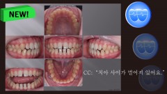 교정 Case 1379.  비발치, Anterior Space를 Close하는 Mechanic Ideas, Sem #3