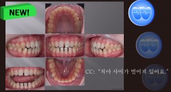 교정 Case 1379.  비발치, Anterior Space를 Close하는 Mechanic Ideas, Sem #3