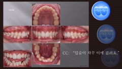 교정 Case 1389. 비발치, Dental Deepbite, Sem #6