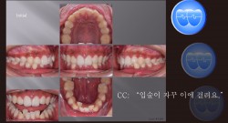 교정 Case 1389. 비발치, Dental Deepbite, Sem #6