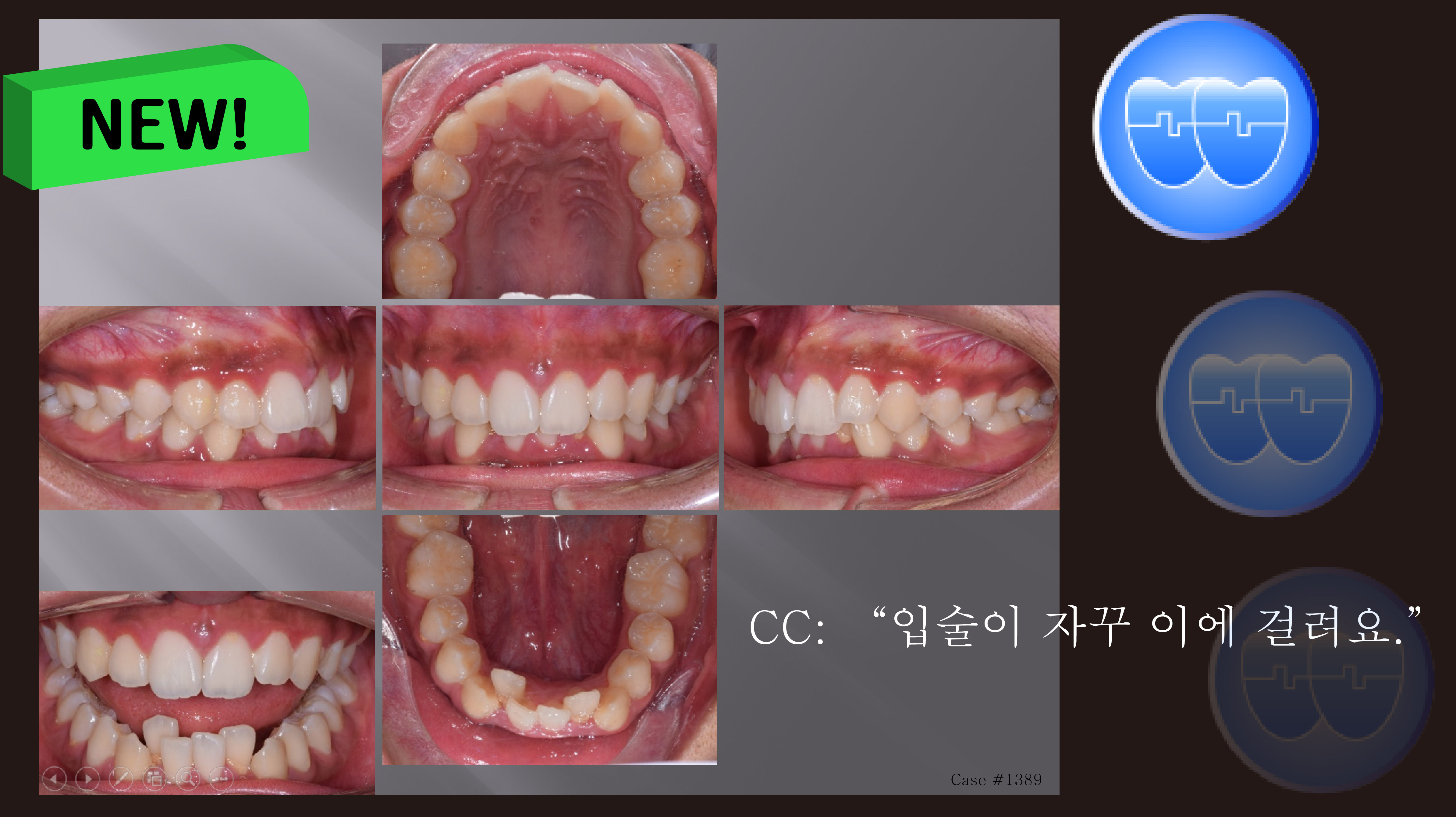 교정 Case 1389. 비발치, Dental Deepbite, Sem #6