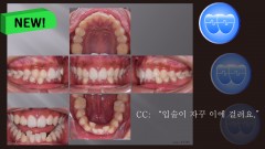 교정 Case 1389. 비발치, Dental Deepbite, Sem #6