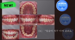 교정 Case 1389. 비발치, Dental Deepbite, Sem #6