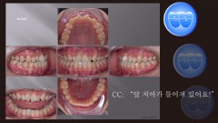 교정 Case 1372. 비발치, Anterior and Posterior Crossbite, Rotation of Anter. Teeth, Sem #16