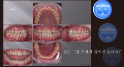 교정 Case 1372. 비발치, Anterior and Posterior Crossbite, Rotation of Anter. Teeth, Sem #16