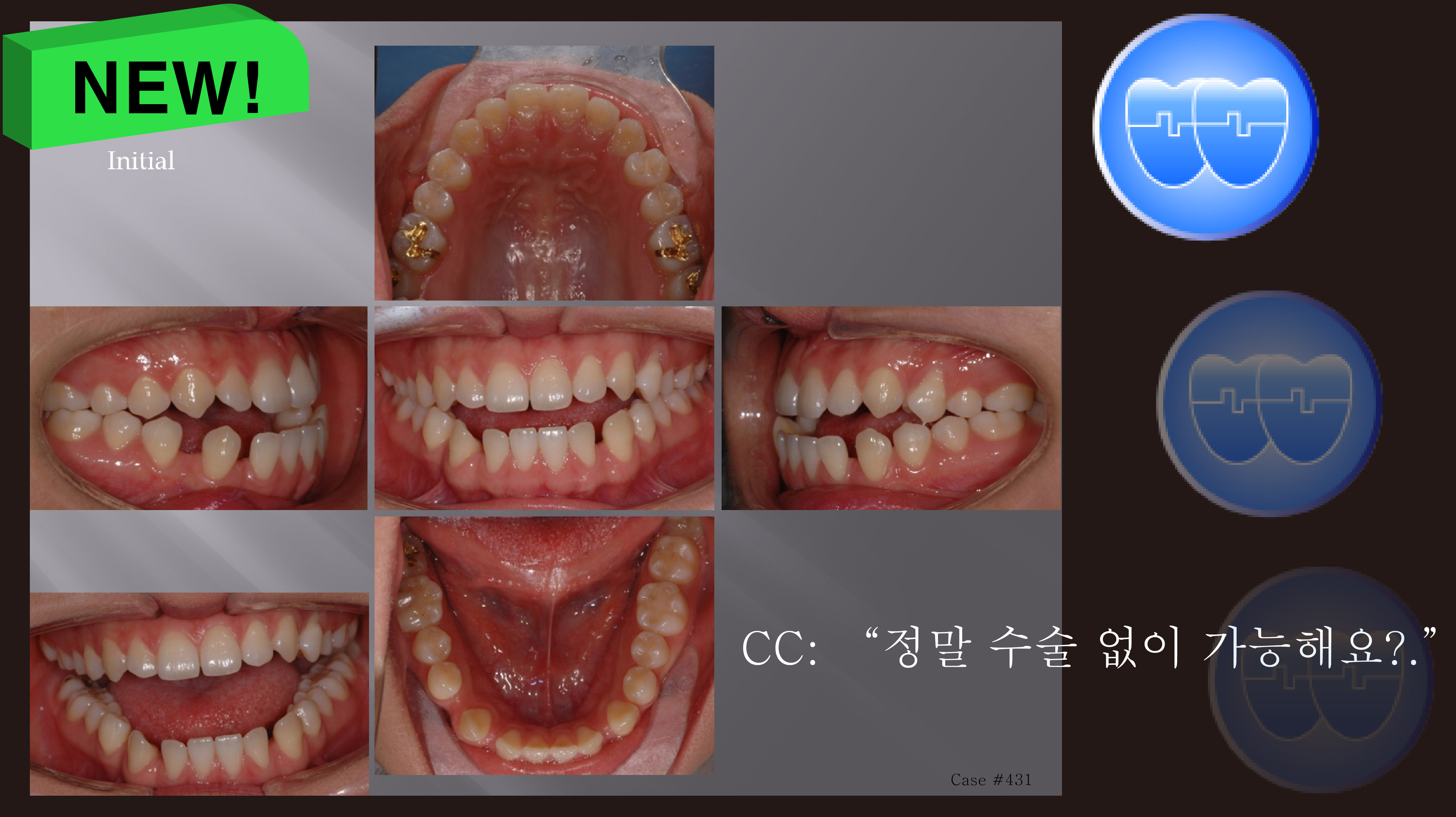 교정 Case 431. Openbite, 비발치, Intrusion of Upper Molars with MIA, Corticotomy, Sem #7